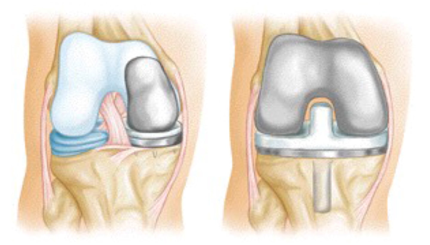 Arthroscopy Knee