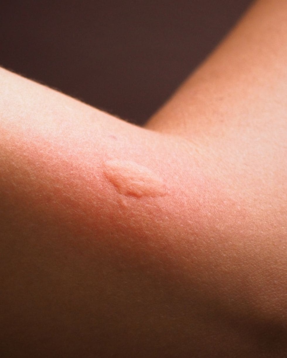 Picadura de mosquito brazo