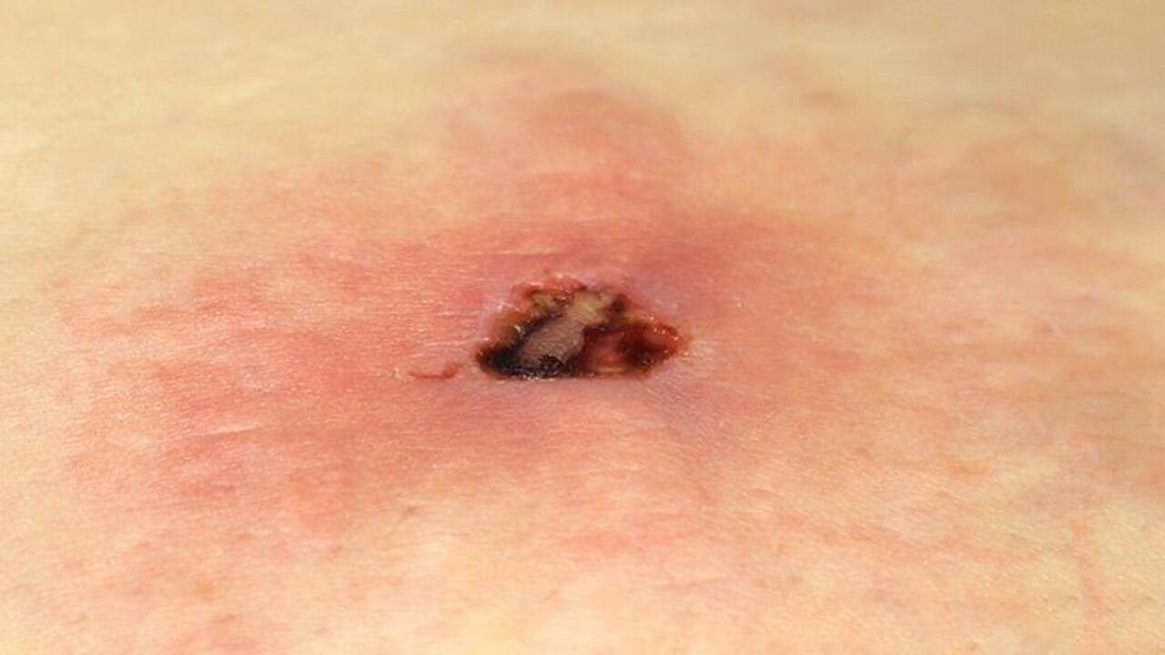 Brown recluse spider bite