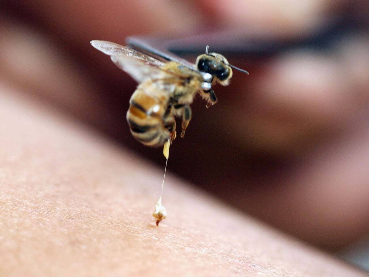 alergia picadura de abeja